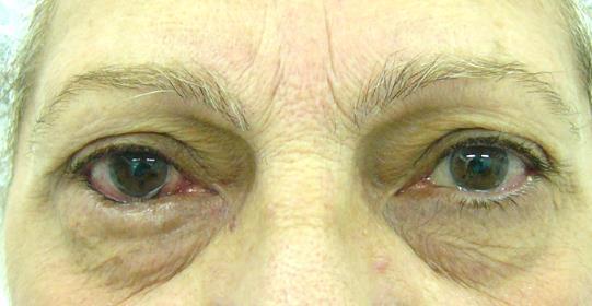 Фигура 59. Инволутивен ентропион на долен клепач на дясно око -А, един месец след операцията с латерална тарзална лента -Б.