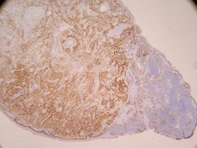 меланофаги; инвазиращи в ретикуларната дерма и сред мускулните клетки