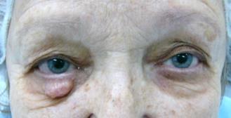 Фигура 80. Базоцелуларен карцином на долен клепач на дясно око -А, седем месеца след операцията Б. А Б Фигура 81.