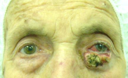 БЦК на долен клепач на ляво око -А, три месеца след операцията