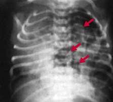 Клинично значение абнормност на структурите (вродени дефекти, травми): диафрагмална херния възможност за дрениране на черния дроб над нивото на диафрагмата без отваряне на плеврална