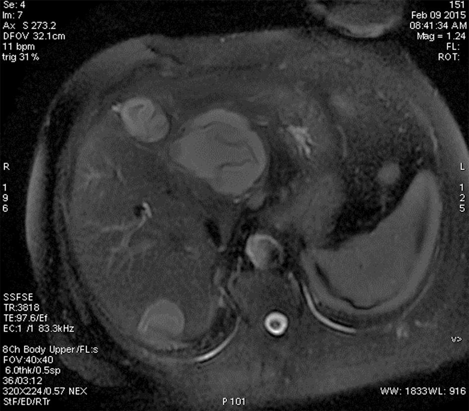 Приложение на компютърната и магнитнорезонансната томография при чернодробна ехинококоза Описани са 3 типа вкалцяване: 1. Цялостно и плътно, пръстеновидно вкалцяване на стената на кистата. 2.