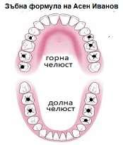 67. При преглед зъболекарят установил, че пациентът А.И. има 11 зъба с кариеси, като отразил това върху зъбната му диаграма (виж фигурата).