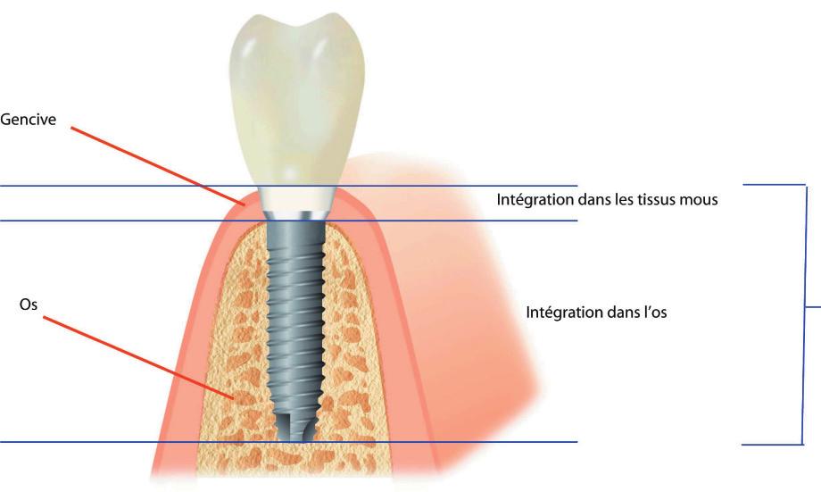 Пародонтологичната интеграция в оралната имплантология: Как да работим с хибридни импланти Автор: Оливие Бенаму Лекар по дентална медицина Принципът за Пародонталната интеграция е едно от основните